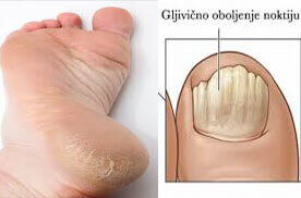 gljivična oboljenja noktiju i kože